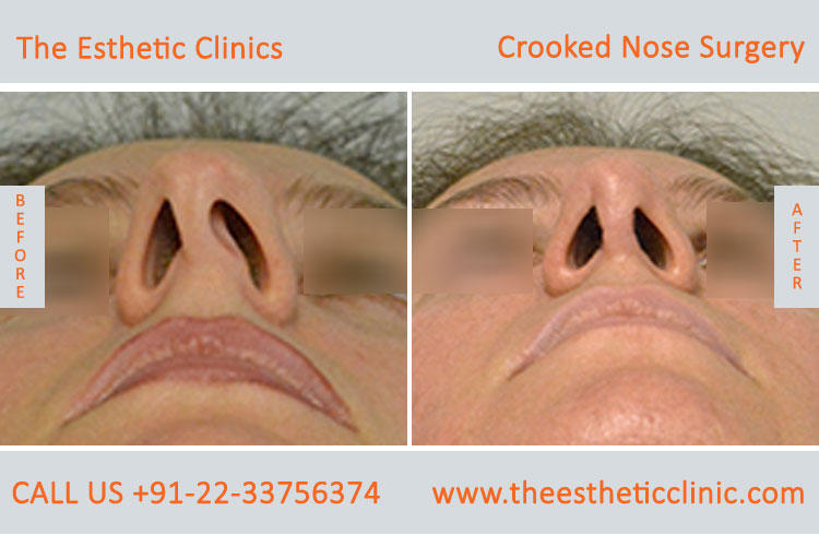 Crooked Nose Surgery before after photos in mumbai india (6)